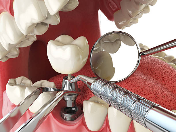 Best Emergency Root Canal Treatment in Cornelius, NC